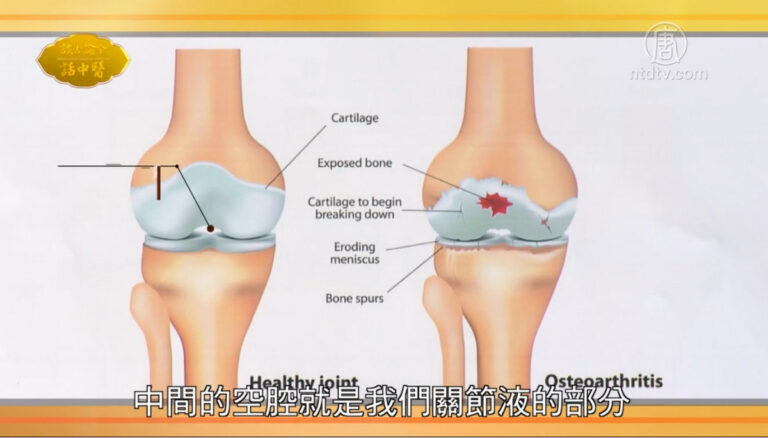 談古論今話中醫：退化性關節炎