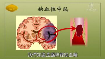 談古論今話中醫：腦中風快速復健