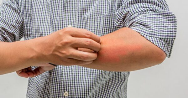 疥疮堪称“最痒皮肤病”传染力强 5招预防