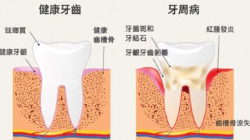 華人好發的口腔疾病──牙周病