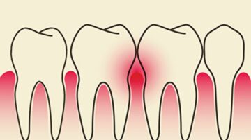 古今人都為牙齒所苦 中醫如何對付牙周病？