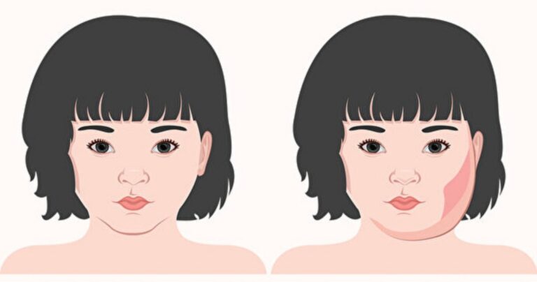 腮腺炎一生只感染一次？發燒、腮部腫脹是症狀