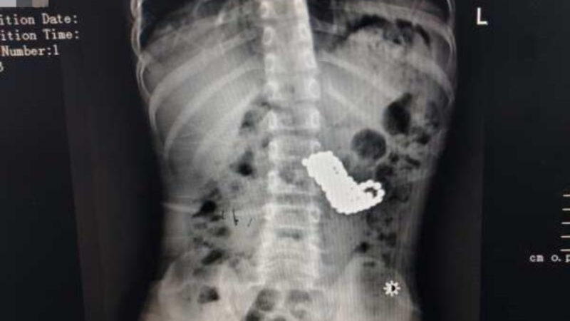 贵州5岁男童吞123颗磁力珠 医生惊呼：首次见到