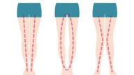 孩子O型或X型腿怎么办？一些症状当心是疾病