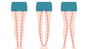 孩子O型或X型腿怎麼辦？一些症狀當心是疾病