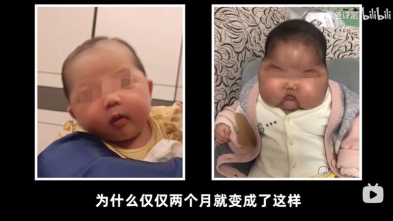 激素嬰兒霜惹禍？ 中國再現大頭娃