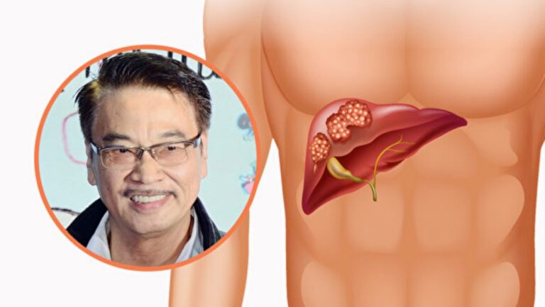 吳孟達病逝 肝癌一發現多是晚期奪命快 3招預防