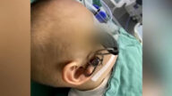 整支鑰匙插入2歲童太陽穴 醫驚：險插進眼球