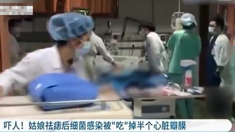 浙江20歲女大學生除痣 心臟被細菌「吃」掉一半