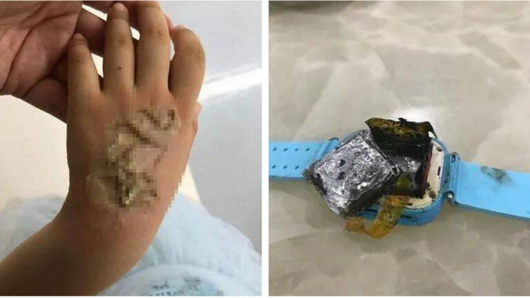 電話手錶自燃 福建4歲女童被嚴重燒傷