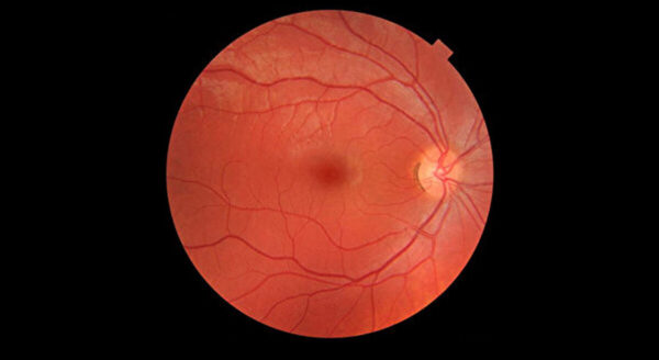 研究：视网膜老化情况可预知早逝风险