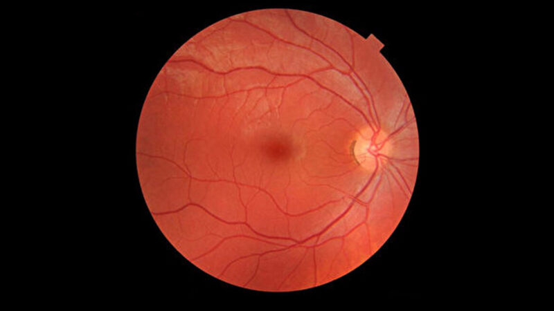 研究：視網膜老化情況可預知早逝風險