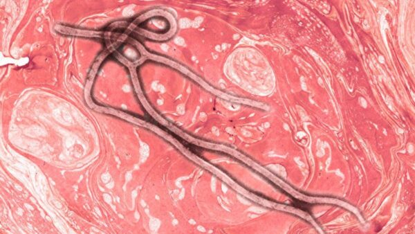 研究：埃博拉病毒可藏脑中 治愈后还会复发