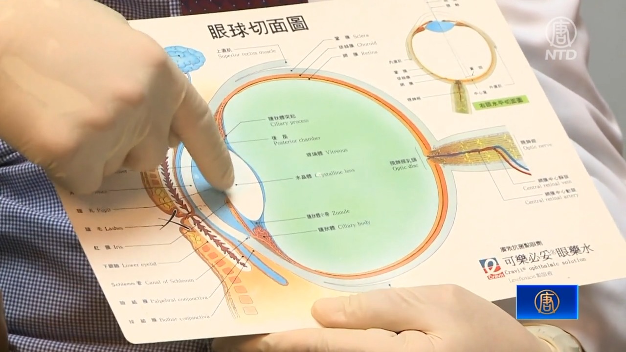 年纪轻轻看不清！白内障误以为近视 严重恐失明