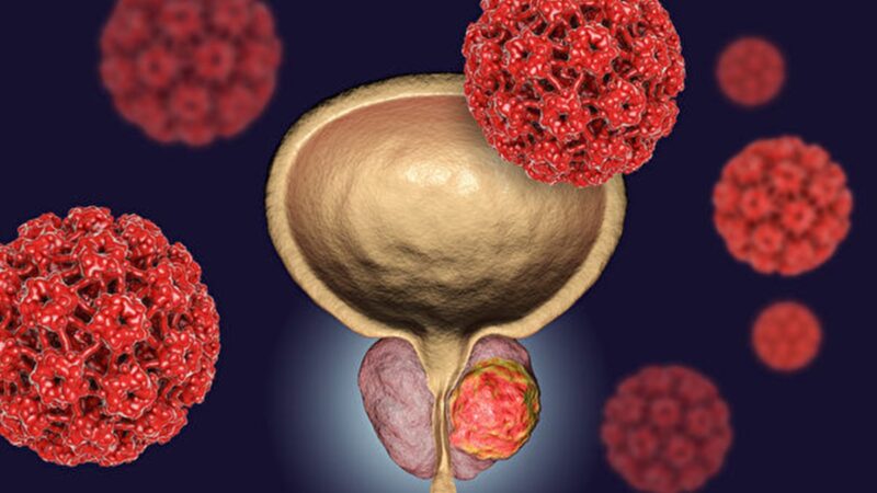 研究發現前列腺癌與五種細菌相關