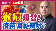 【健康1+1】猴痘爆發 疫苗能預防嗎？