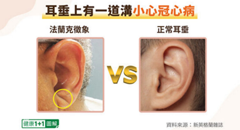 耳朵1徵兆恐是冠心病！按按耳朵防心臟病、高血壓