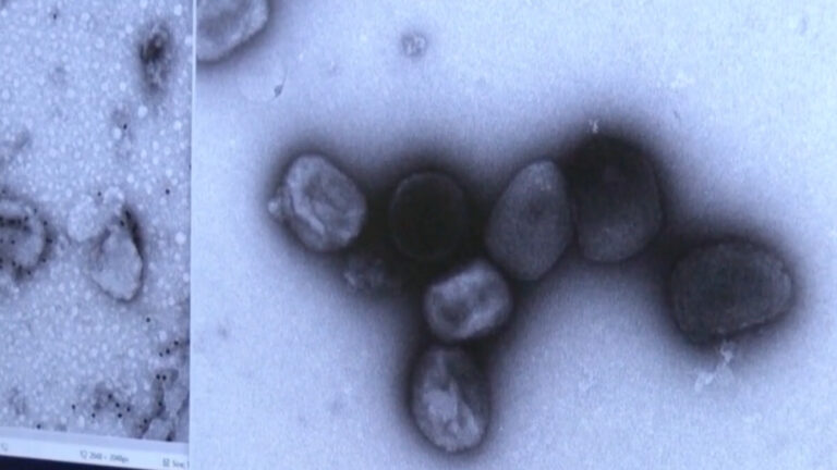 洛縣疑現首個猴痘病例 等待CDC確認