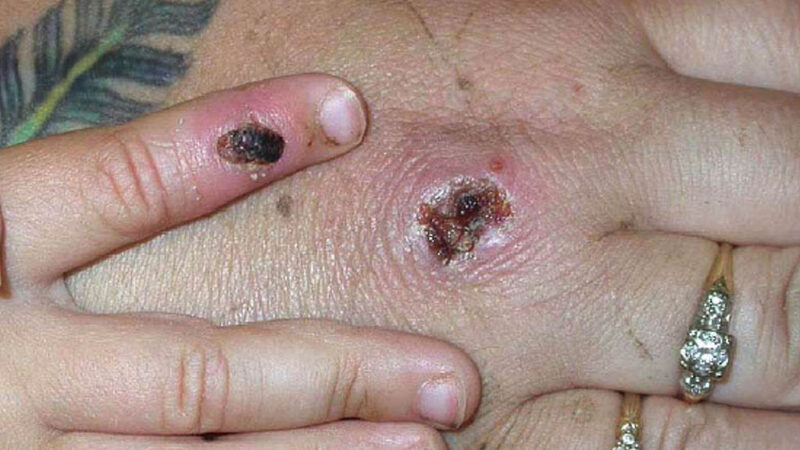 全球超过一千例确诊 美CDC升级猴痘警报