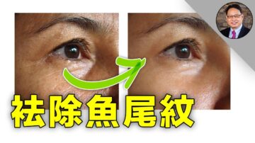 【四維健康】怎樣用自然方法消除魚尾紋？