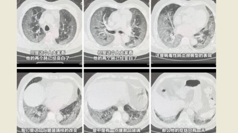 [新聞] 中國疫情密集出現合併肺炎 醫師：這不是