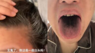 江苏女染疫“一夜白头” 天津男舌头牙齿变黑（视频）