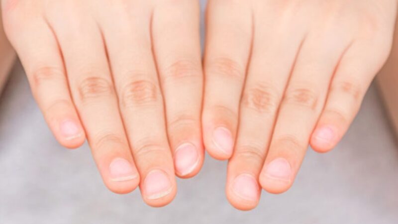 指甲10种异状要警惕健康
