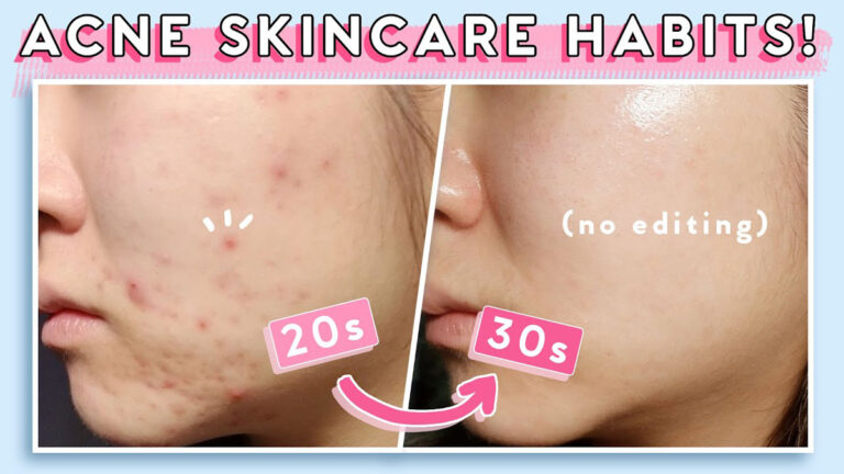 【Beauty Within】適用油性膚質青年人的5個祛痘技巧