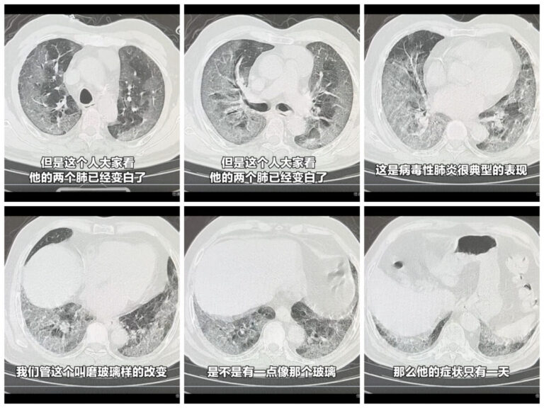 中國出現「白肺」現象 美專家：這說不通