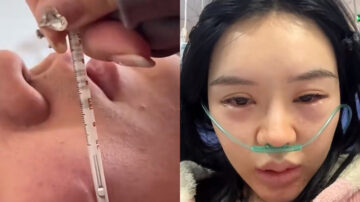 男子高燒體溫計貼臉狂飆 女子燒三天用上呼吸機（視頻）