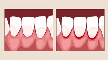 別讓牙齒走不歸路 牙齦發炎8大原因及改善方法