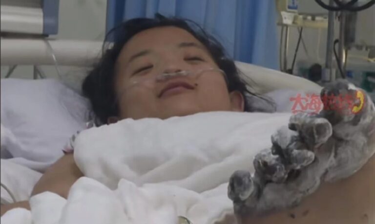 瀋陽女孩充電時玩手機遭電擊 腳趾被燒焦面臨截肢