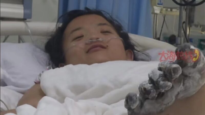瀋陽女孩充電時玩手機遭電擊 腳趾被燒焦面臨截肢