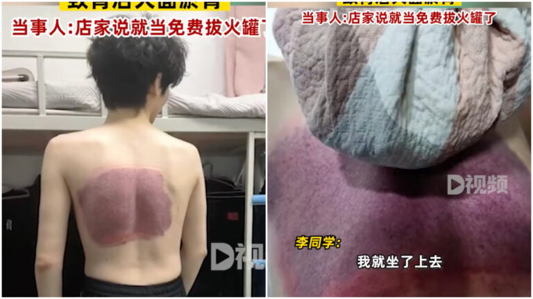 男生泡澡被排水口吸出大片淤青 店家：當免費拔火罐了