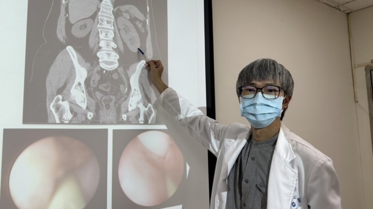 婦人健檢輸尿管有結石 意外發現擁3顆腎臟