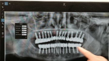優惠價格！整齊牙科邀您體驗先進植牙技術