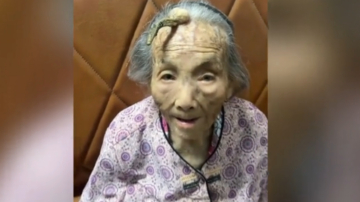 廣東107歲奶奶額頭長出罕見「壽角」