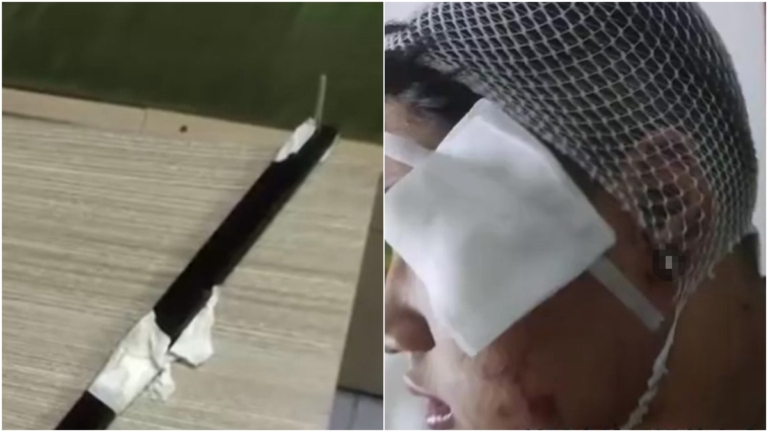 山西17歲學生被8名同學群毆 頭上滿是窟窿眼