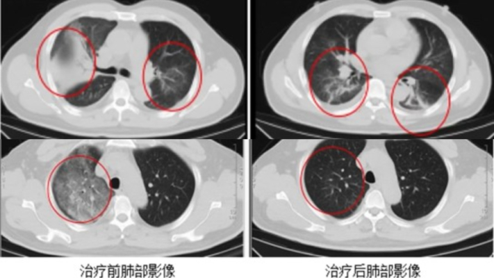 中國江蘇確診一例罕見傳染病「Q熱」