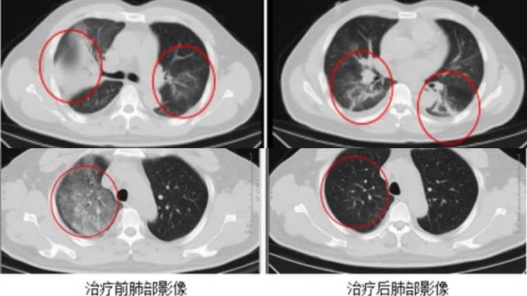 深圳一男子患罕見傳染病 高燒一週用藥無效