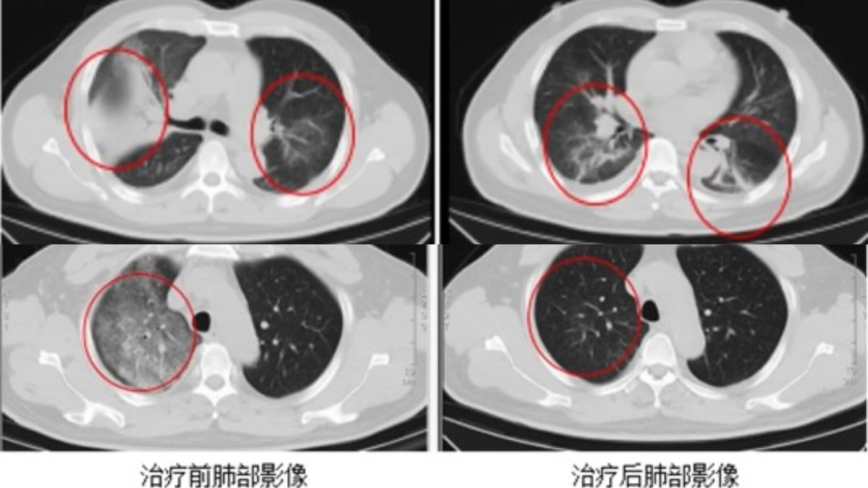 中国江苏确诊一例罕见传染病“Q热”