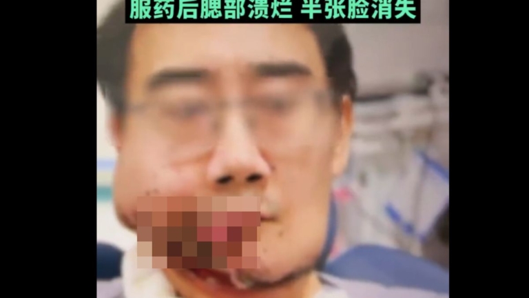 慎入：大陸男子患癌花40多萬治療 半張臉沒了