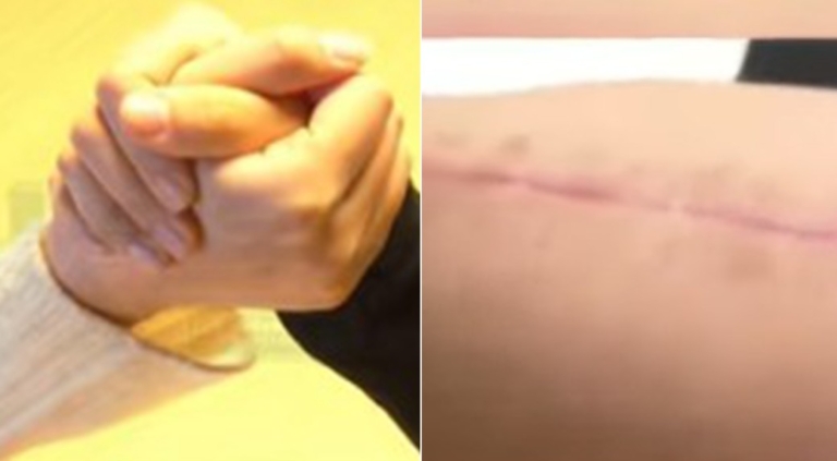 河南27歲女參加掰手腕比賽 「咔嚓」一聲胳膊掰斷