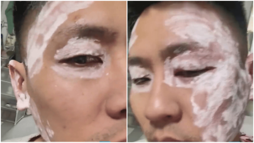 中国餐厅纸巾有毒？男子擦脸后险毁容