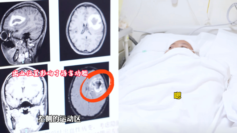 廣州24歲女生症狀離奇 英語很好的她突然不會說了