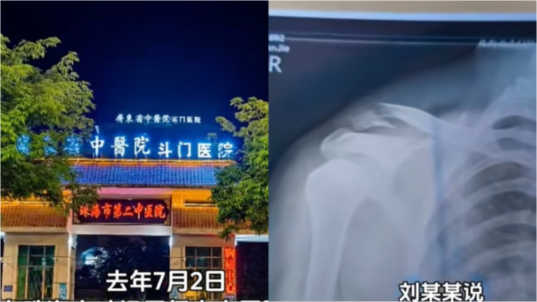 醫生也被坑？粵醫生骨折被勸回本院治療現「骨溶解」