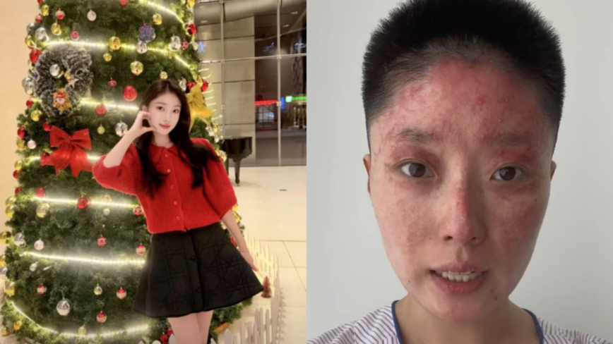 中国27岁美女网红惨遭毁容式烧伤 事故原因曝光