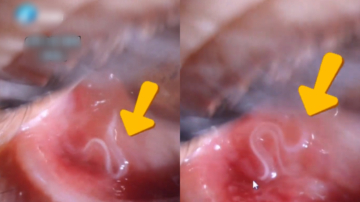 河南女孩眼睛痒 洗脸时拽出三条活虫