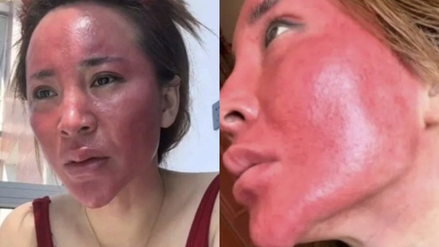 吉林女22年不卸妆 皮肤结硬壳 脸红如“关公”