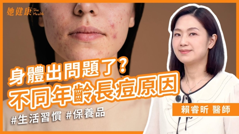 【她健康】四大壞習慣造成痘痘臉！日常保養四大關鍵！